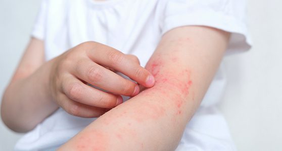 Uma fotografia mostrando o braço de um paciente com alergia representando a necessidade do Seguro responsabilidade civil produtos.